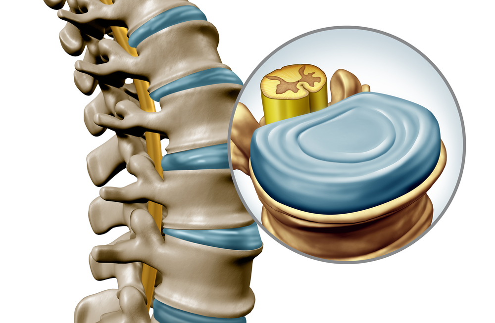 Spinal Discs – What Are They?