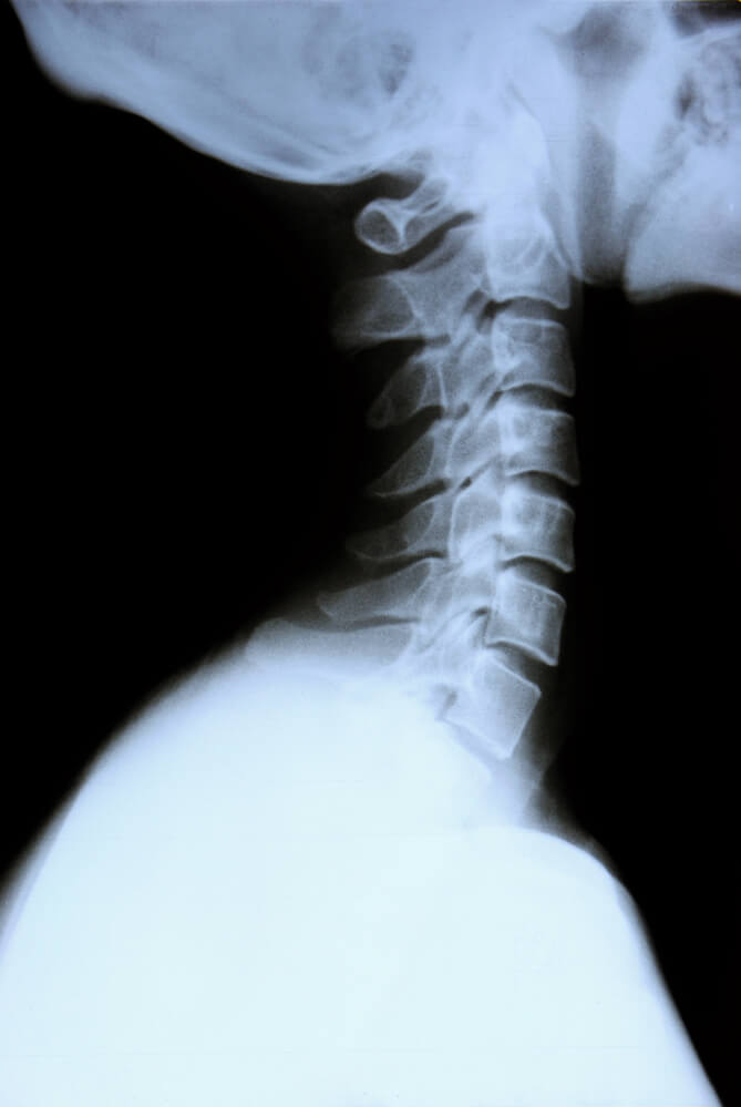 The Anatomy of the Cervical Spine