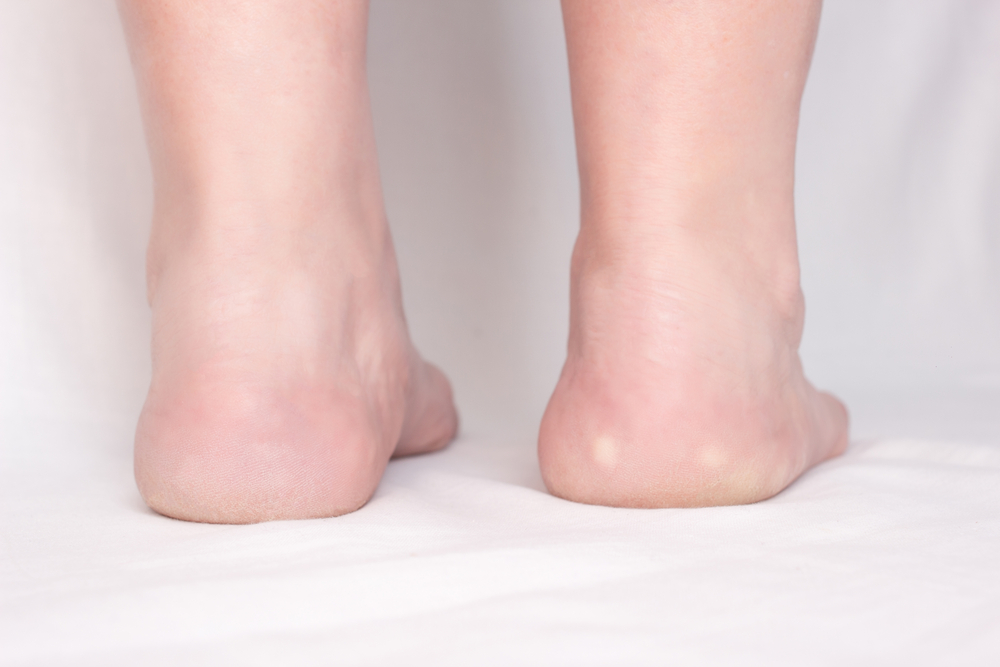 The Pain Producing Heel Spur