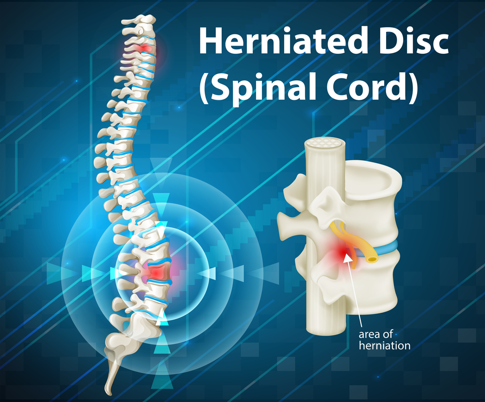 Herniated Discs: Symptoms, Risk Factors, and Treatment Strategies