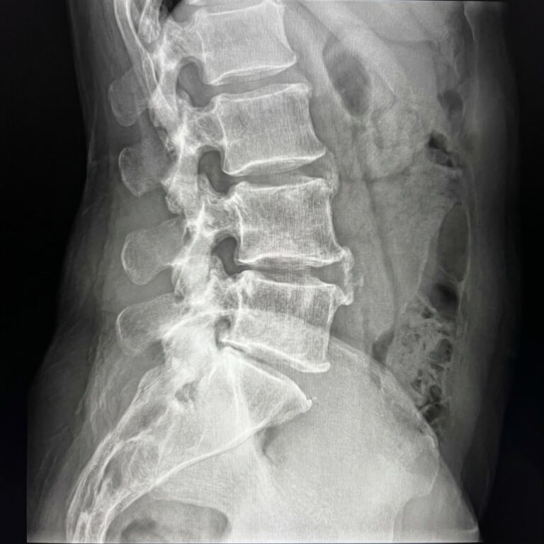 Side-view X-ray of the lumbar spine showing age-related changes linked to spinal stenosis